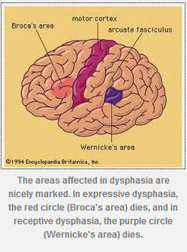 Dysphasia Difference Between